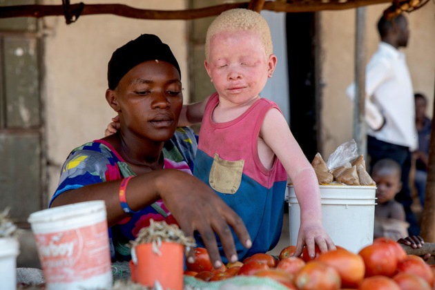 Als &quot;weiße Schwarze&quot; ständig in Gefahr / CBM fordert zum Welt-Albinismus-Tag mehr Aufklärung
