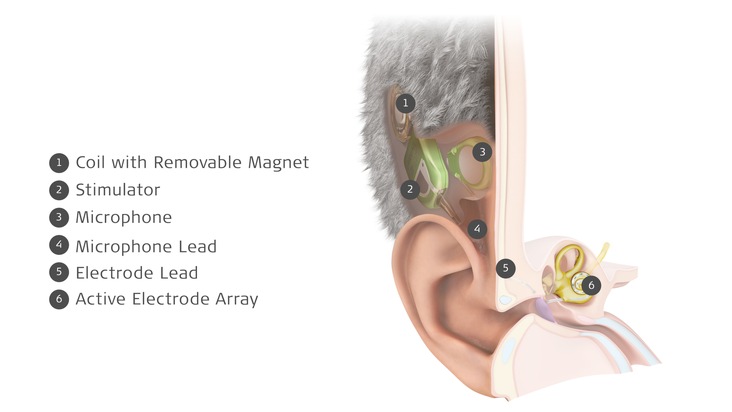 MED-EL lance le premier implant cochléaire invisible au monde