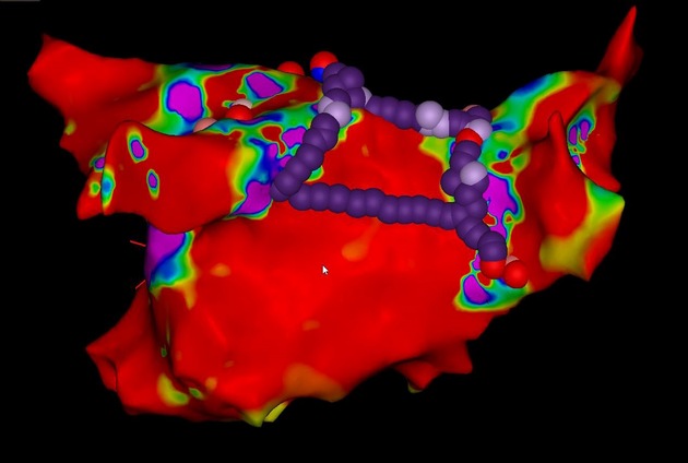 Premiere im Herzkatheterlabor: Innovatives Behandlungsverfahren bei Vorhofflimmern am RHÖN-KLINIKUM Campus Bad Neustadt