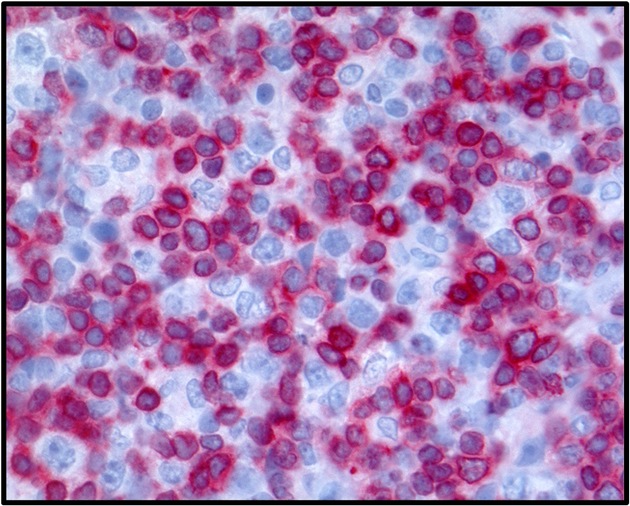 Bessere Therapie gegen schwer behandelbaren Lymphdr&uuml;senkrebs: DFG f&ouml;rdert Forschungsprojekt REACT