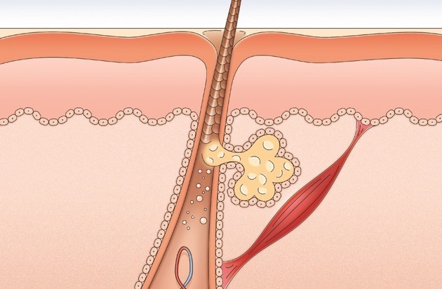 Dr. Wolff-Forschung: British Journal of Dermatology veröffentlicht neue Studie / Coffein fördert Haarwachstum (FOTO)