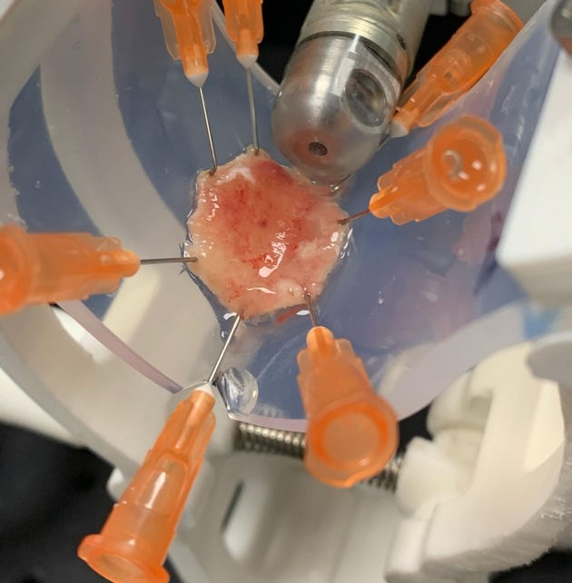 New Endoscopy Technology Enables Early Detection of Esophageal Cancer