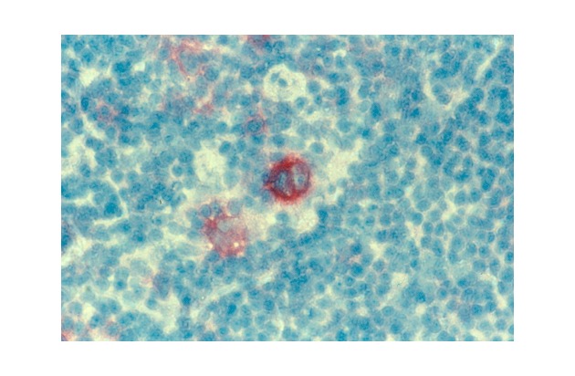 Rund 10 Millionen Euro für bessere Therapien gegen Lymphdrüsenkrebs