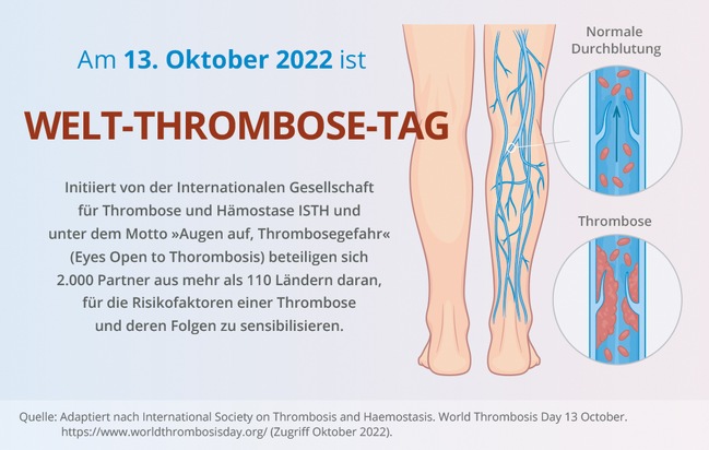 Fachpressemitteilung: Welt-Thrombose-Tag – Jede vierte Todesursache jährlich wird durch eine venöse oder arterielle Thrombose bedingt