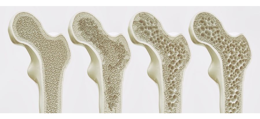 Hart im Nehmen, aber nicht im Knochen: Osteoporose bei Männern