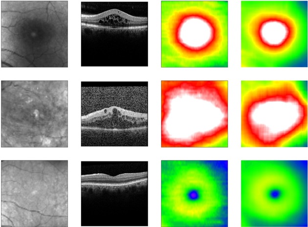 Deep Learning in Kliniken: Neue Methode ermöglicht automatisierte Diagnose diabetesbedingter Augenkrankheit