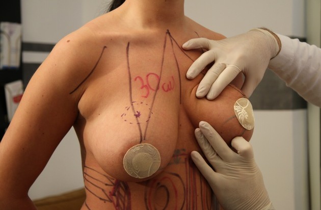Mc Aesthetics UG: Brustvergrößerung mit Implantaten, die Kunst der schönen Brüste