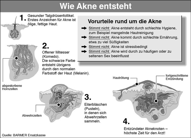 Akne ist heilbar - der Arzt hilft dabei / BARMER, Hautärzte und Pharmaunternehmen wollen Teenagern helfen, die Krankheit Akne zu besiegen / Informationen per Hotline