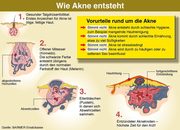 Akne ist heilbar - der Arzt hilft dabei / BARMER, Hautärzte und Pharmaunternehmen wollen Teenagern helfen, die Krankheit Akne zu besiegen / Informationen per Hotline