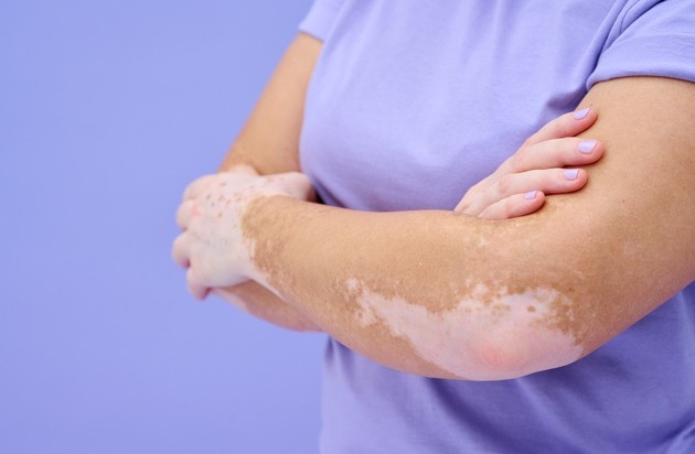 Beratung für Vitiligo-Betroffene: Incyte Deutschland unterstützt die Hautwochen