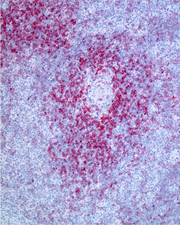 DFG f&ouml;rdert Forschungsprojekt REACT: Bessere Therapie gegen schwer behandelbaren Lymphdr&uuml;senkrebs