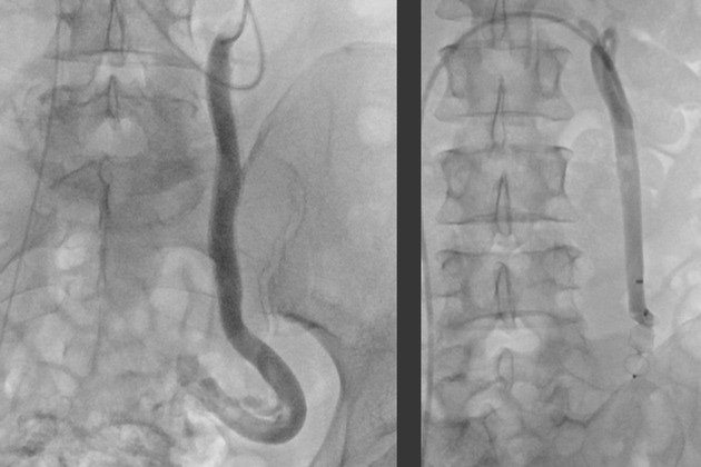 Beckenvenensyndrom: Eine oft &uuml;bersehene Ursache chronischer Unterleibsschmerzen