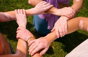 Incyte Biosciences Germany GmbH: Die Feiertage genießen, auch mit Vitiligo: Warum die Weihnachtszeit Menschen mit Vitiligo besonders herausfordert