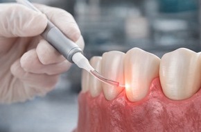 KU64 Zahn&auml;rzte Dr. Ziegler & Partner: Laserbehandlung bei KU64: Schonend, schmerzarm und pr&auml;zise f&uuml;r gesundes Zahnfleisch