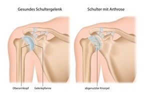 ATOS Gruppe GmbH & Co. KG: Arthrose in der Schulter