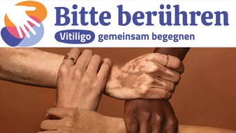 Incyte Biosciences Germany GmbH: "Bitte berühren" - Kampagnenstart zum Welt-Vitiligo-Tag