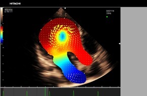 Hitachi Medical Systems Europe Holding AG: Hitachi Medical Systems Europe introduces the third generation of non-invasive intracardiac blood flow visualization technology, at EuroEcho Imaging 2018
