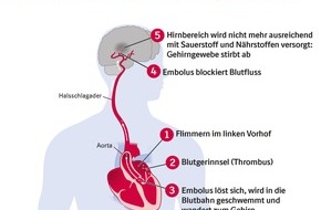 Boehringer Ingelheim: Weltschlaganfalltag am 29. Oktober: Vorhofflimmern - möglicher Vorbote eines Schlaganfalls (FOTO)