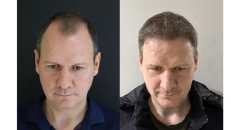 EsteFavor: Die 10 Besten Haartransplantationskliniken in der T&uuml;rkei - Kosten, Dauer & Erholungszeit