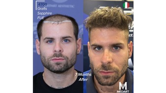 EsteFavor: Die 10 besten Haartransplantationszentren in der Türkei: Kompletter Ratgeber für ausländische Patienten 2026