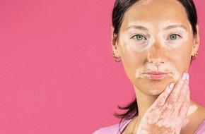 Incyte Biosciences Germany GmbH: Welt-Vitiligo-Tag: Die Zeit ist reif - Für Betroffene mit Vitiligo lohnt sich ein Besuch beim Facharzt