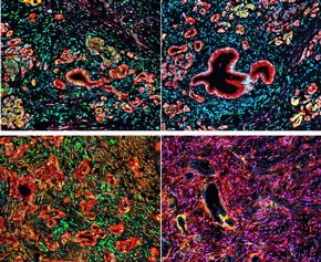 Millionenf&ouml;rderung f&uuml;r Bauchspeicheldr&uuml;senkrebs-Forschung