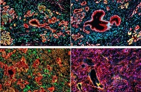 Universit&auml;tsklinikum Essen A&ouml;R: Millionenf&ouml;rderung f&uuml;r Bauchspeicheldr&uuml;senkrebs-Forschung