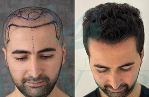 EsteFavor: Top 10 Beste Haartransplantation Kliniken in der Türkei