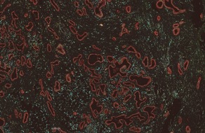 Millionenf&ouml;rderung f&uuml;r Bauchspeicheldr&uuml;senkrebs-Forschung