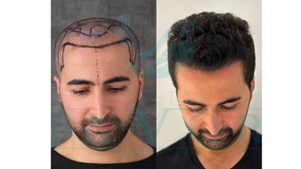 EsteFavor: Top 10 Beste Haartransplantation T&uuml;rkei in der T&uuml;rkei 2026: testsieger Haartransplantationskliniken