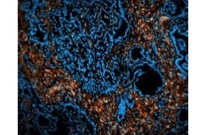 Universitätsklinikum Essen AöR: Tumorforschung: Neue Radioimmunotherapie macht aggressive und bislang schwer behandelbare Krebsarten (wieder) angreifbar