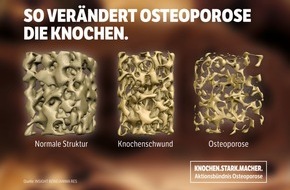 Aktionsbündnis Osteoporose: Osteoporose? - Da können Sie etwas tun!