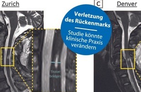 Universitätsklinik Balgrist: MEDIENMITTEILUNG / PRESS RELEASE – Halswirbelsäulenverletzung: Studie hat das Potenzial, die klinische Praxis zu verändern / Cervical spine injuries: Study has the potential to change clinical practice