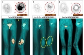 Medias Klinikum GmbH & Co KG: The world's first Extended Isolated Stopflow Limb Infusion (EISLI) to treat osteosarcoma results in complete remission