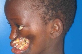 Schweizerische Zahnärzte-Gesellschaft SSO: Società svizzera di odontologia e stomatologia: La noma - una malattia che distrugge il viso dei bambini