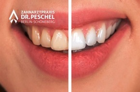 goodRanking Online Marketing Agentur: Ist eine Zahnaufhellung schädlich?