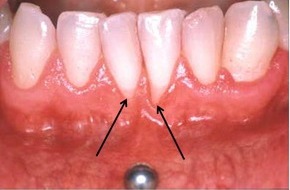 GABA International AG: Piercing de la bouche : un bijou aux conséquences nocives