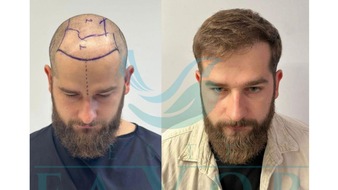 EsteFavor: Haartransplantation T&uuml;rkei 2026 - Die 10 besten Kliniken im gro&szlig;en Testsieger-Vergleich