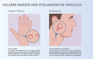 Viatris Germany GmbH: Fachpressedienst: Neue Produktentwicklungen bei EndWarts st&auml;rken die bew&auml;hrte Produktlinie zur Selbstbehandlung von Warzen