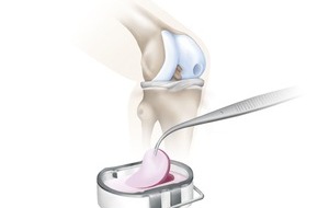 B. Braun Melsungen AG: Knorpel biologisch Heilen: 300. Patient mit High-Tech Knorpeltransplantat operiert