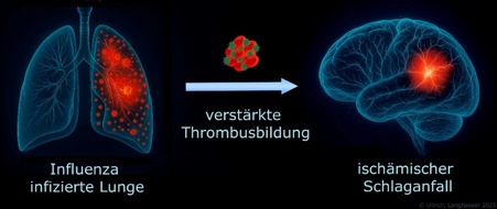 Universitätsklinikum Essen AöR: Grippe erhöht Schlaganfallrisiko
