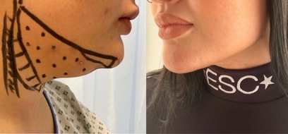 Mc Aesthetics UG: Doppelkinn Pandemie und Jawline Hype in der Schönheitschirurgie