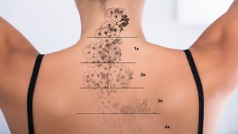 Dermatologie Quist: Dermatologie Quist: Tattooentfernung mit dem Picosekundenlaser – alles über Vorteile, Risiken und Vorgang