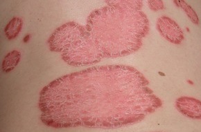 LEO Pharmaceutical Products Sarath Ltd.: Journée Mondiale du Psoriasis, 29.10.2012: Fiche d'information sur le psoriasis (IMAGE)