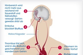 Boehringer Ingelheim: Neun von zehn befragten Patienten mit Vorhofflimmern sorgen sich um ihr Schlaganfallrisiko und wollen in Therapieentscheidungen einbezogen werden (FOTO)