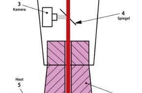 Technische Hochschule Köln: Tätowierungen entfernen mit Laser und Ultraschall