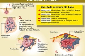 BARMER: Akne ist heilbar - der Arzt hilft dabei / BARMER, Hautärzte und Pharmaunternehmen wollen Teenagern helfen, die Krankheit Akne zu besiegen / Informationen per Hotline