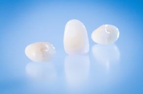 imex Dental Group: Top Zahnästhetik zum sensationellen Preis / Die iKrone® gibt es jetzt auch für den Frontzahnbereich (BILD)