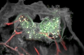 Universitätsklinikum Essen AöR: Überraschender Fund bei Glioblastomen: Inseln potenter Abwehrzellen im lokalen Knochenmark