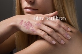 Berufsverband der Deutschen Dermatologen e. V.: Diskriminierung im Netz: Soziale Plattformen zensieren Fotos von Schuppenflechte-Betroffenen / "Bitte berühren"-Kampagne macht sich stark gegen Stigmatisierung